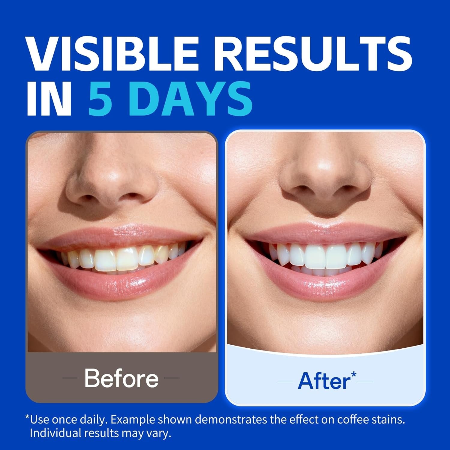 Teeth Whitening Strips – Professional Dentist Approved, Gum-Safe Formula, 28 Non-Slip Strips, 14 Treatment, Pain-Free Express Whitening Kit in 30 Min, Easy to Use for Bright Smile